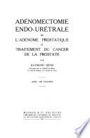 Adénomectomie endo-urétrale de l'adénome prostatique et traitement du cancer de la prostate