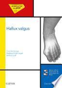 Hallux valgus