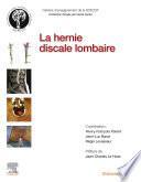 La hernie discale lombaire