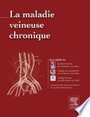 La maladie veineuse chronique