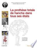 La prothèse totale de hanche dans tous ses états