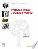 Prothèse totale d'épaule inversée