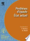 Prothèses d'épaule. État actuel